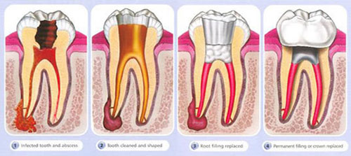 How is root canal therapy (RCT) carried out and why?