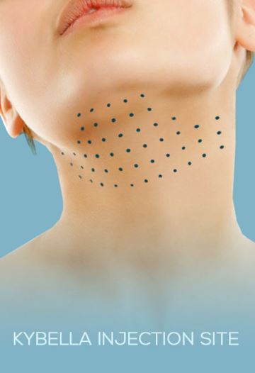Kybella Treatment In Plano
