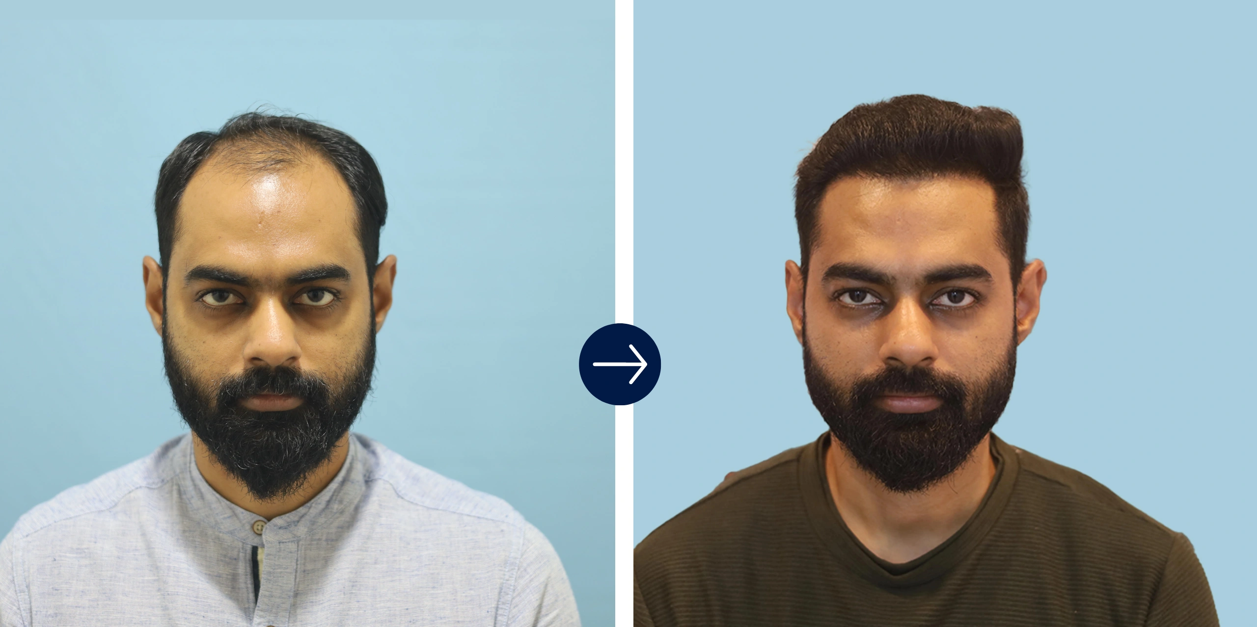 Hair Transplant Clinic in Bhubaneswar