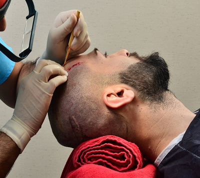 Hair transplant in Islamabad