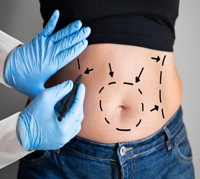 Liposuction in Islamabad