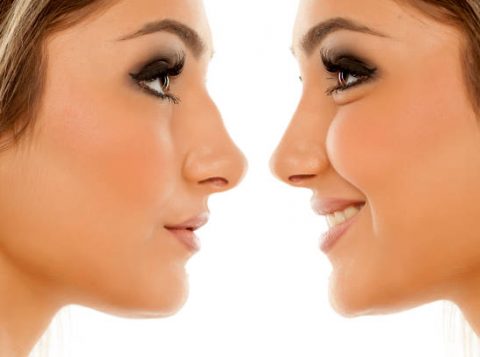 Rhinoplasty in Islamabad
