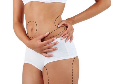 Liposuction in Islamabad