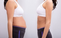 Tummy Tuck in Islamabad